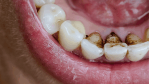 Black stain denti: macchie da vicino