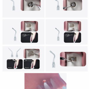 Serie di passaggi odontoiatrici con ALTAQI-KIT compatibile SATELEC® per la pulizia del canale radicolare.