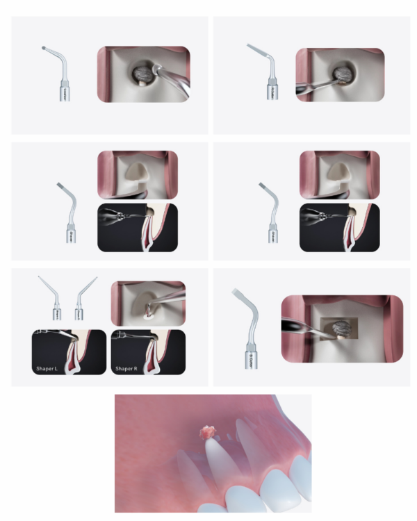 Serie di passaggi odontoiatrici con ALTAQI-KIT compatibile SATELEC® per la pulizia del canale radicolare.